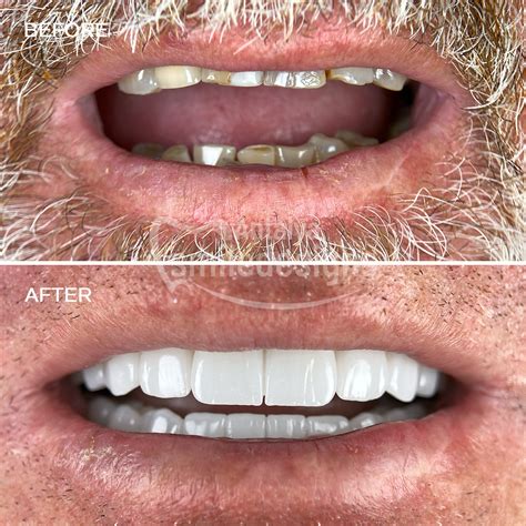 Premium snap on dentures kit – Artofit