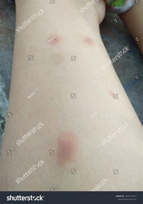 Sand Fly Bites On Human Leg Foto Stok 1445173412 | Shutterstock