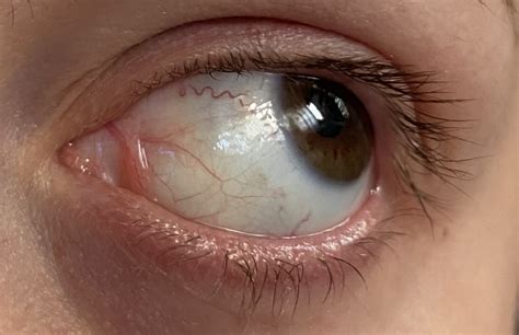 Swollen Lacrimal Caruncle Feels