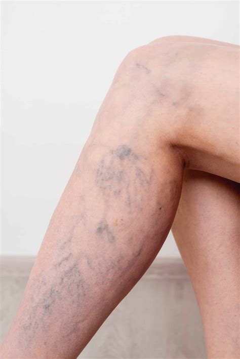 Are Varicose Veins Dangerous? What To Watch Out For | Dr. Malvehy