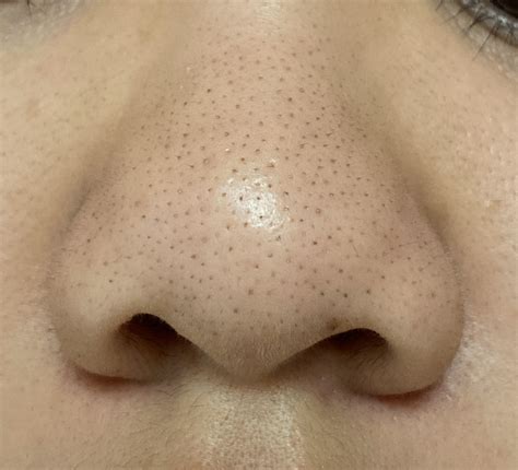 [SKIN CONCERN] How do I minimize the appearance of sebaceous filaments/blackheads on my nose ...