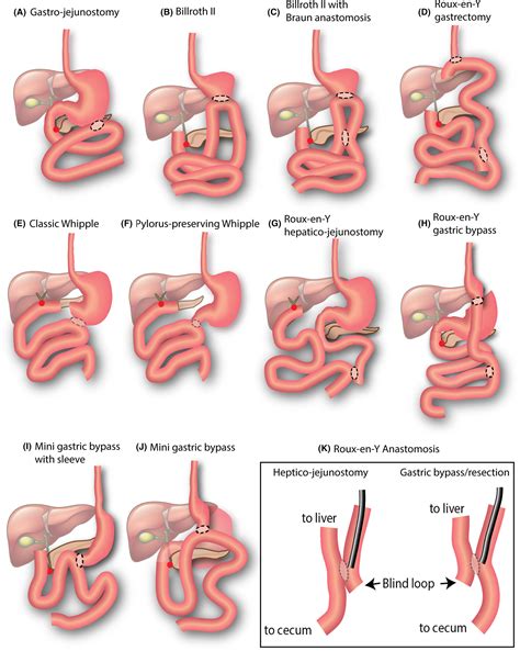 Billroth 2 Anatomy Choledochoduodenostomy Combined With Billroth II
