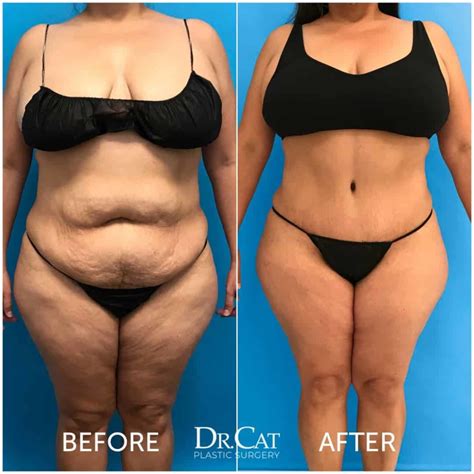 Tummy Tuck Prices Procedure