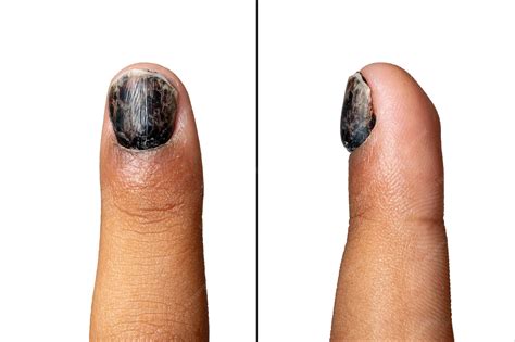 압궤 외상으로 인한 검은 손톱 혈종으로 인해 손톱이 분리되는 원인 흰색 배경에 격리된 위쪽 및 프로필 보기 | 프리미엄 사진