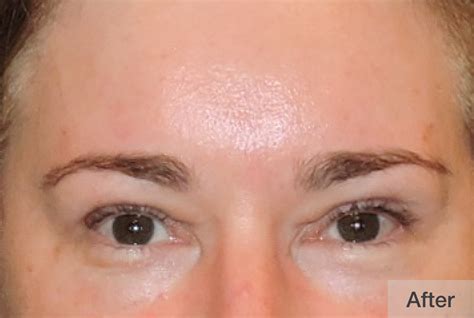 Endoscopic Brow Lift