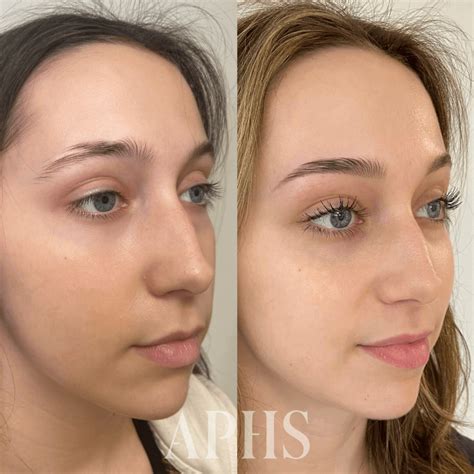 Scar Tissue and Microblading – APHRODITE'S SECRET