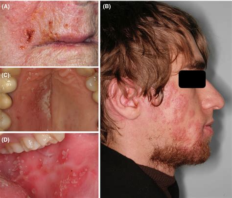 Intraoral Herpes Gums