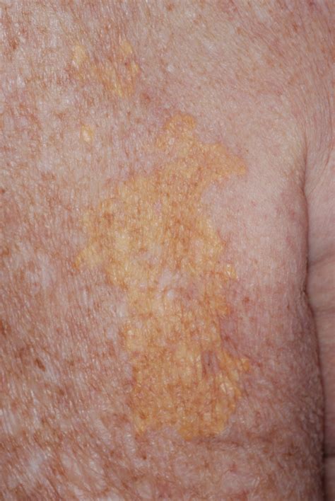 Yellowing Of Skin Yellowish Discoloration Of The Palm | Download