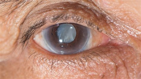Cataracte Des Yeux