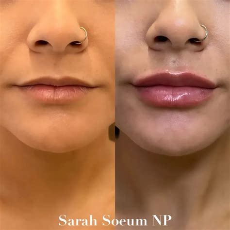 Lip Flip Before and After - Before After Journey