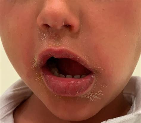 Staphylococcal scalded skin syndrome