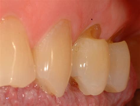 Receding Gum On One Tooth