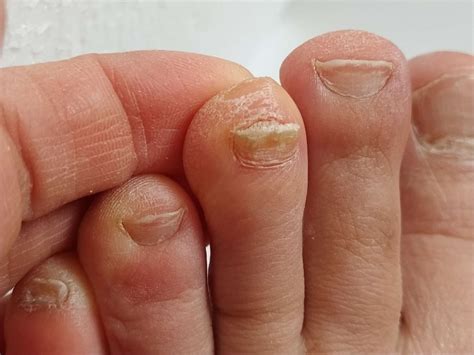 Thick Toenails: Symptoms, Causes, Treatment, and More