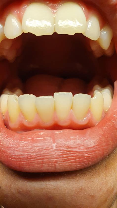 do i have enamel erosion and are my gums receding? : r/DentalHygiene