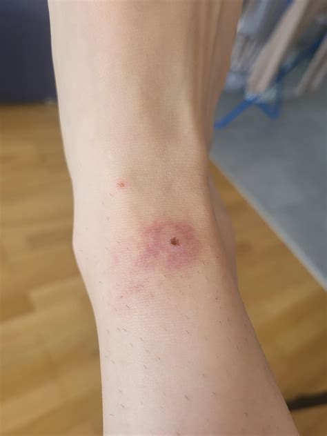 24F in Austria. Suspected bug bite infection : r/medical_advice