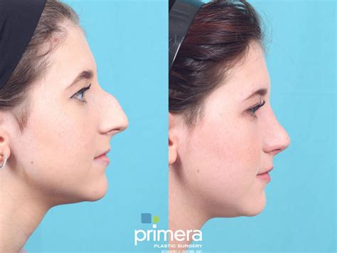 What Are the Different Types of Rhinoplasty Surgeries? Before and After Photos – Primera Plastic ...