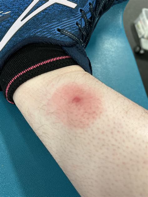 Mrsa / staph aureus infection versus Lymes disease? : r/DermatologyQuestions