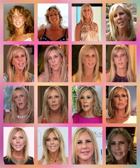 Vicki Gunvalson Face Surgery