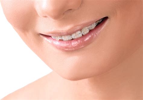 What Do Invisalign Braces Look Like at Wayne Morgan blog