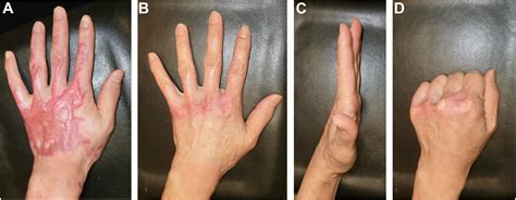Update on Hypertrophic Scar Management in Burn Patients - Clinics in ...