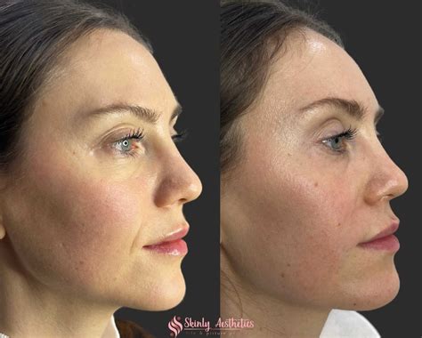 Smile Lift Treatment With Fillers - Benefits, Costs, Results & Procedure Steps