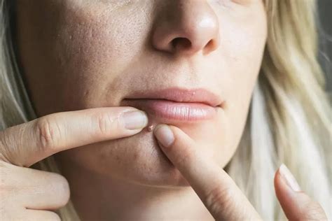 Pop That Zit Pimple Or Cyst? Safety Tips - Liv Hospital