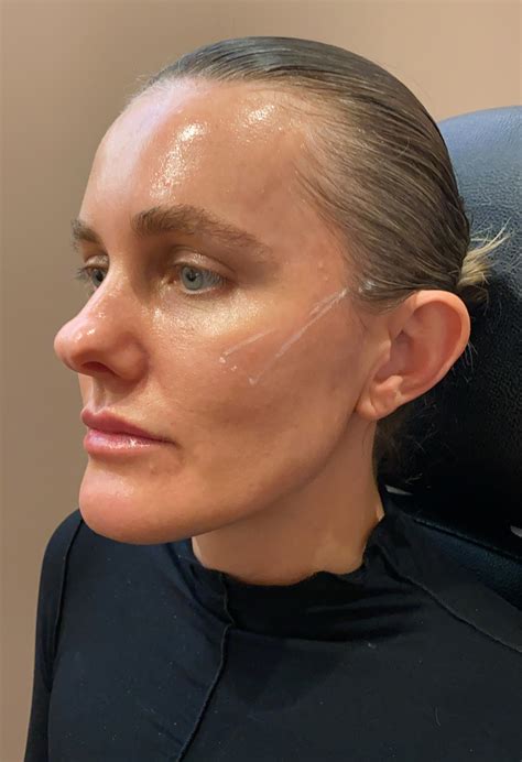 Everything You Need to Know About Thread Lifts | Who What Wear