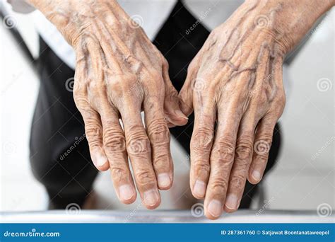 Old Elderly Woman Showing Wrinkled Hands and Bulging Vein on the Back ...