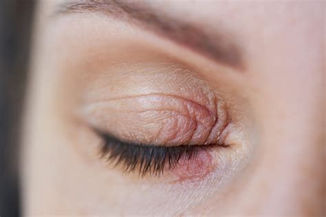 Staph Infection on the Eyelid: Symptoms, Causes, and Treatment