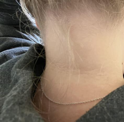 Back of neck creases : r/AcanthosisN