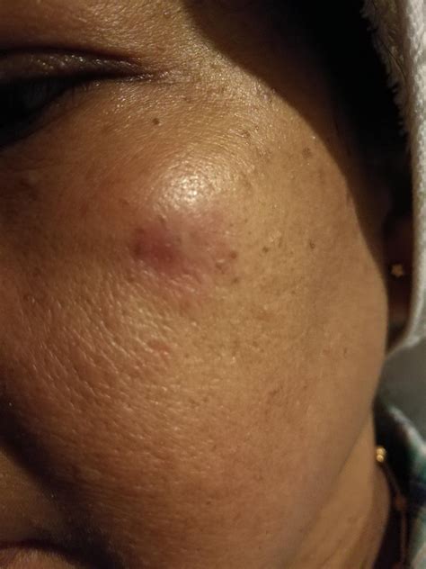 Cyst On Chin Under Skin