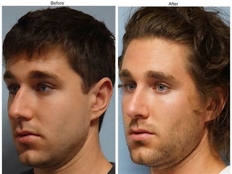 Bad Nose Job Before And After Men