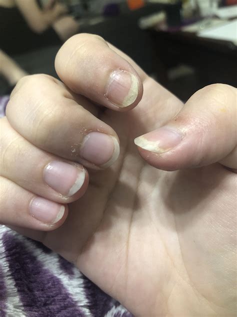 Nail Bed Separating From Nail at Hamish Riddoch blog