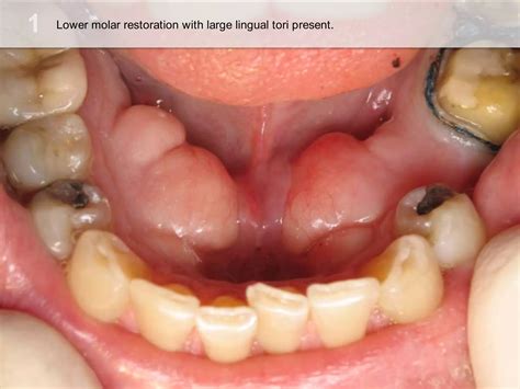 Taking Impressions with Mandibular Tori Interference using Triotray by Dr Graeme Milicich | PPTX