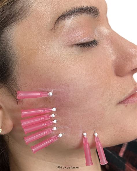 50 Thread lift ideas | thread lift, facial aesthetics, botox