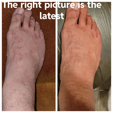 Athlete's foot is spreading : r/DermatologyQuestions