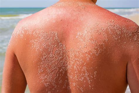 How to Treat Peeling Skin After a Sunburn