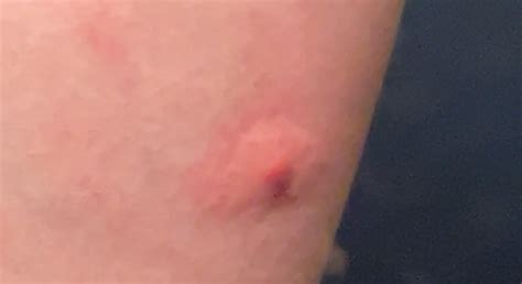 Lump on back, feels hard. Kinda uncomfortable if I’m moving around and rotating my body : r ...