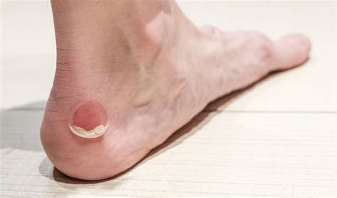 Painful and Sore Blisters on the Foot and Toe #1 Treatment