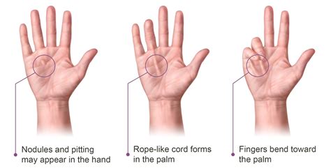 What You Need to Know about Dupuytren's Contracture