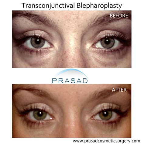 Under Eye Bag Surgery | Prasad Cosmetic Surgery New York
