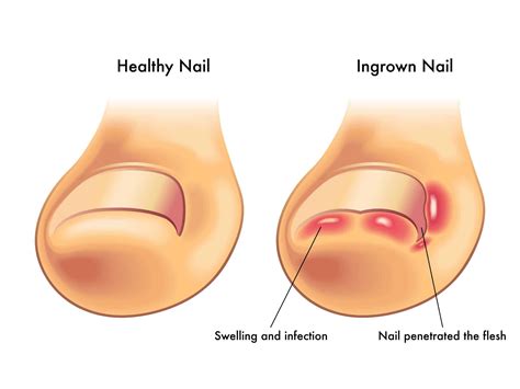 How Do Ingrown Toenails Occur