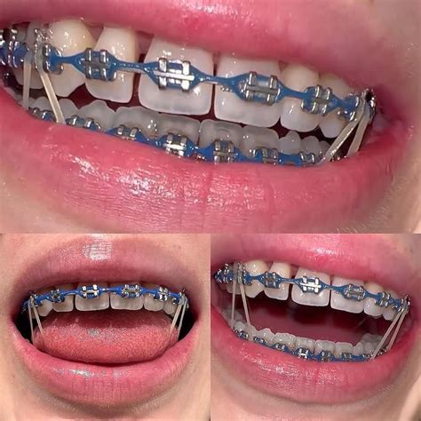Braces Colors Sea Green at Lois Katz blog