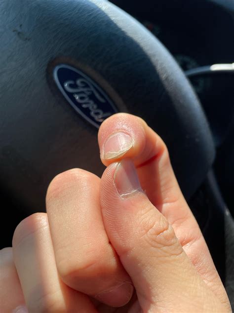 Nail growing under nail : r/nailhealth
