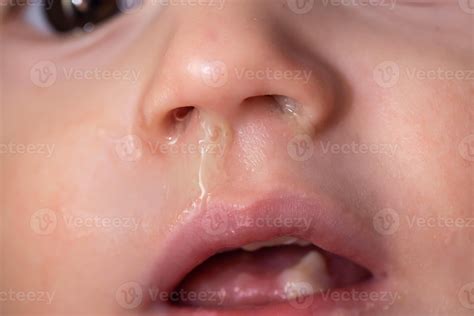 Yellow snot from a child s nose, close-up. Sinus infections, colds and ...