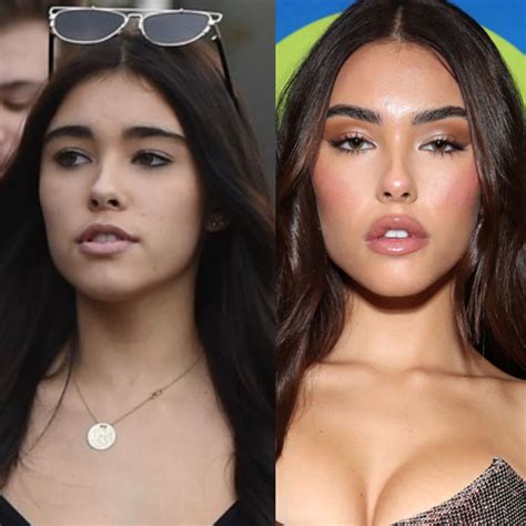 Madison Beer plastic surgery in 2025 | Madison beer plastic surgery, Famous celebrities, Plastic ...