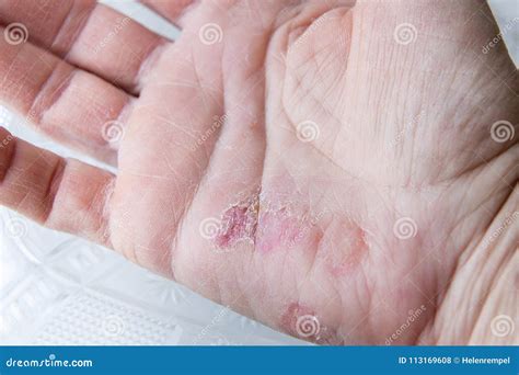 Extreme Sore Dry Cracked And Peeling Skin In The Hand. Stock ...