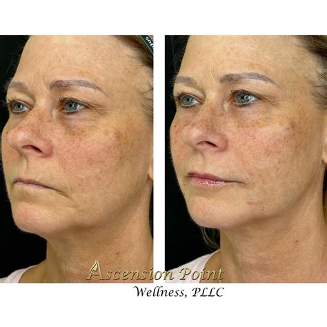 Before & After - Ascension Point Wellness