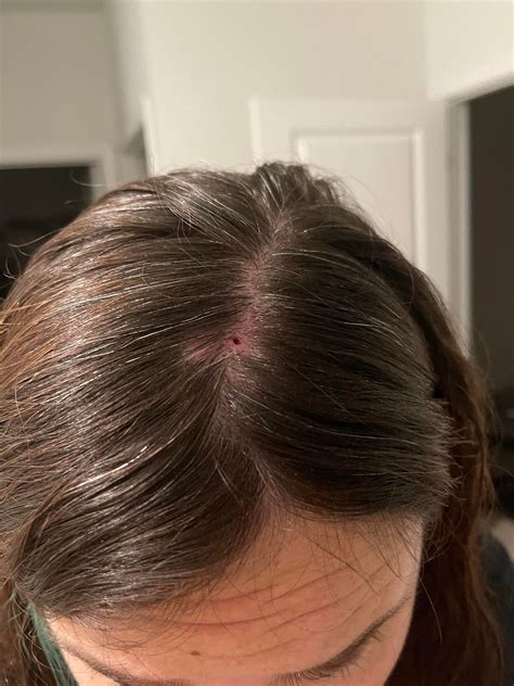 Cyst sac removed from scalp. Had a Pilar cyst removed last year that was huge, and this popped ...