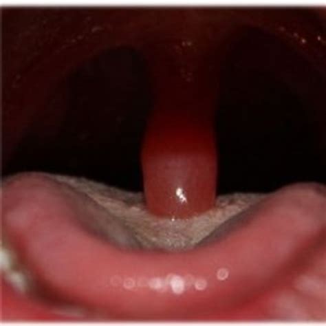 What Does It Mean If Your Uvula Is Swollen And White at Ava Dorsch blog